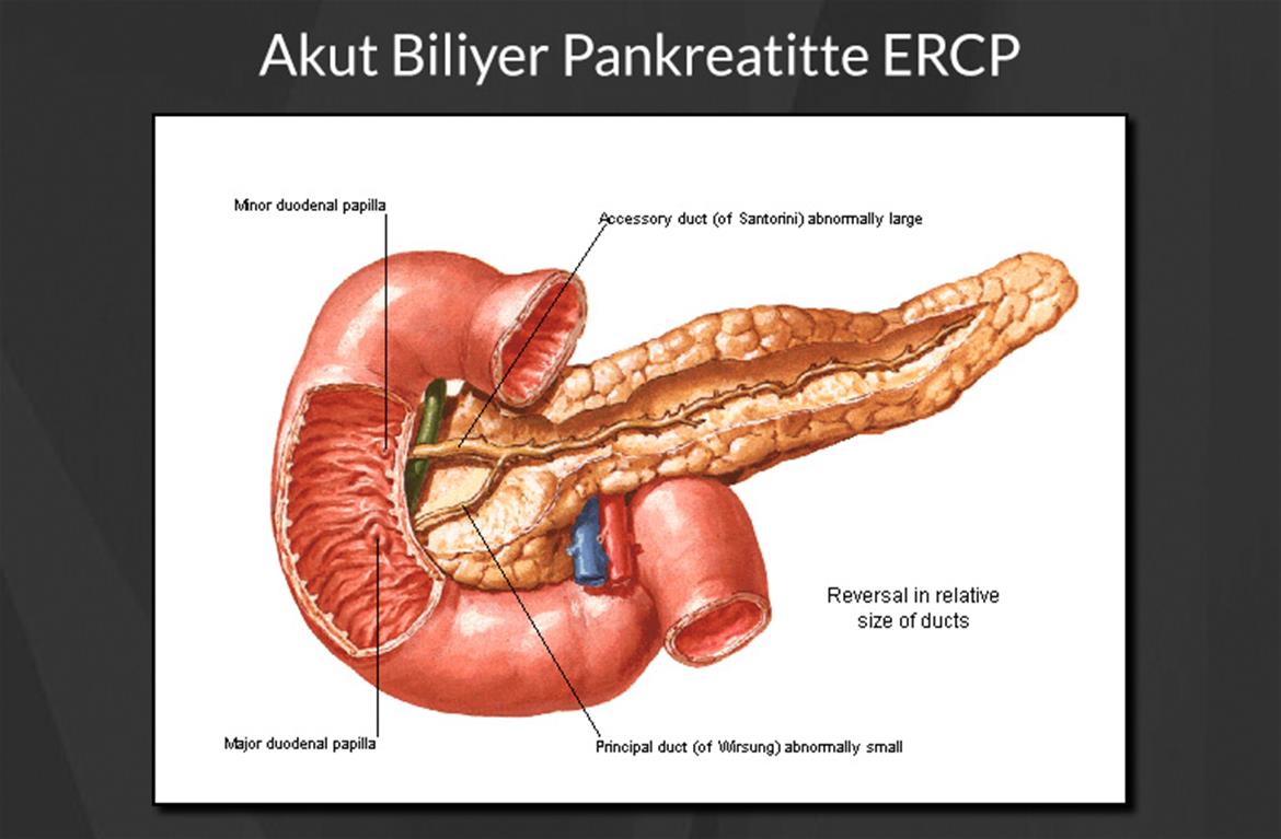 Akut Biliyer Pankreatitte ERCP