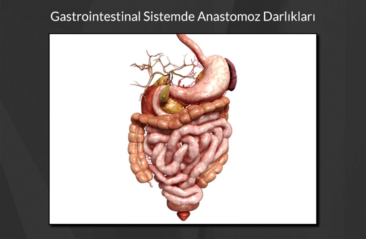 Gastrointestinal Sistemde Anastomoz Darlıkları