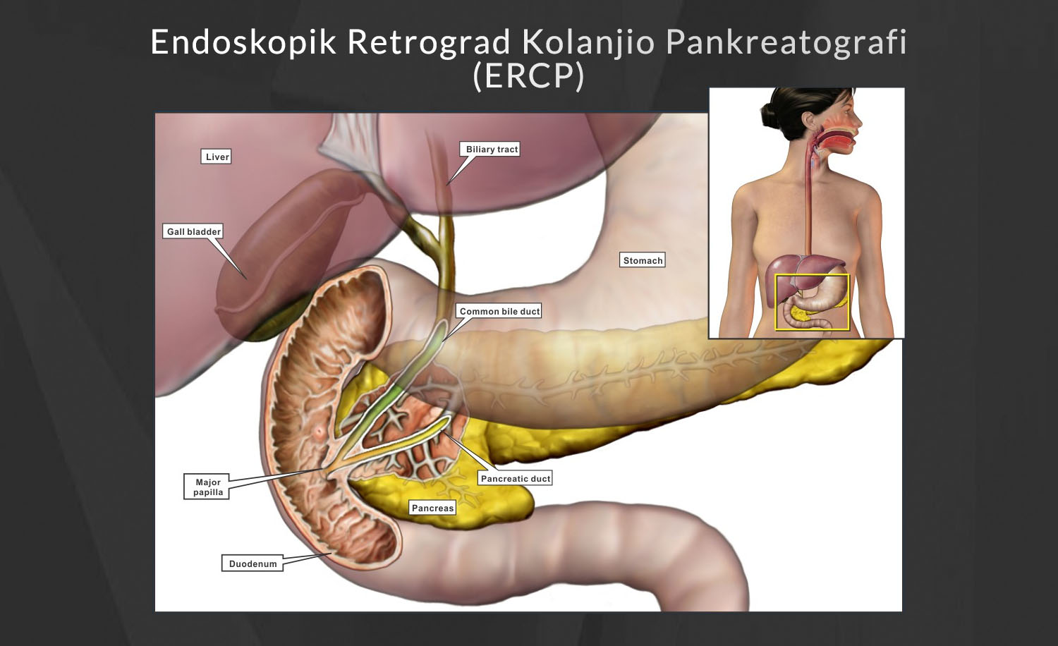 ERCP Uygulamaları - Marmara & Bursa