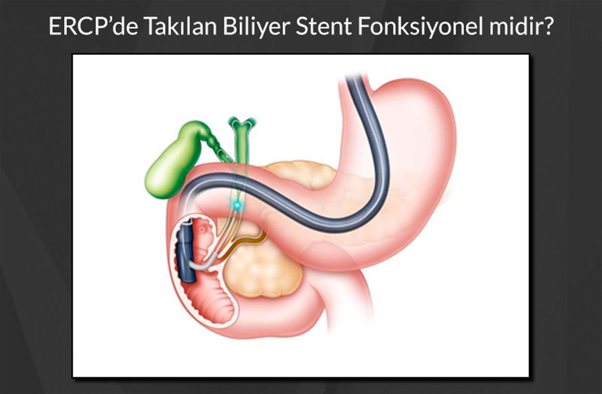 ERCP’de Takılan Biliyer Stent Fonksiyonelliği