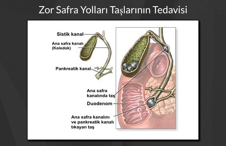 Zor Safra Yolları Taşlarının Tedavisi