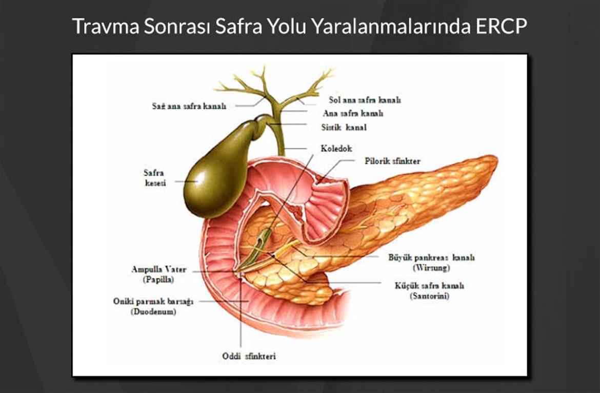 Travma Sonrası Safra Yolu Yaralanmalarında ERCP