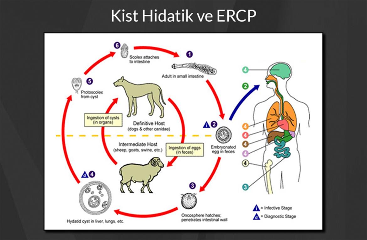 ERCP ve Karaciğer Kist Hidatik