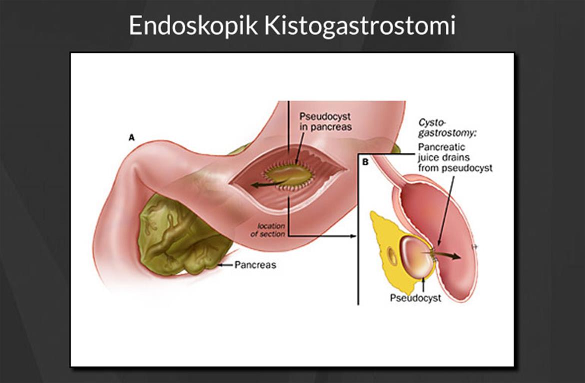 Endoskopik Kistogastrostomi