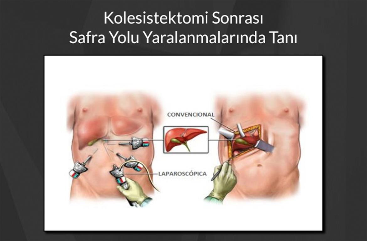 Kolesistektomi Sonrası Safra Yolu Yaralanmalarında Tanı