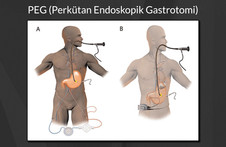 PEG (Perkütan Endoskopik Gastrotomi)