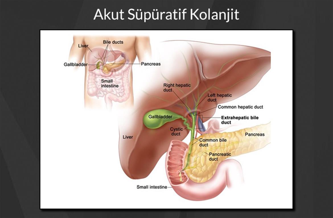 Akut Süpüratif Kolanjit