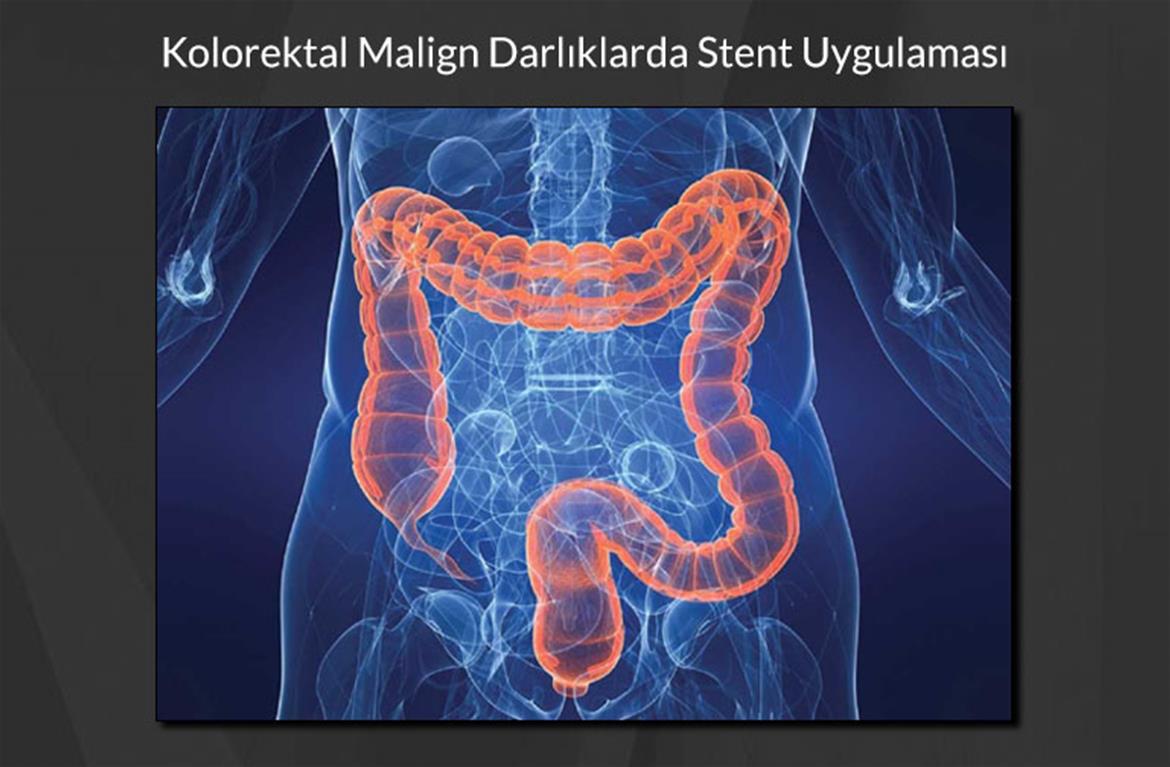 Kolorektal Malign Darlıklarda Stent Uygulaması